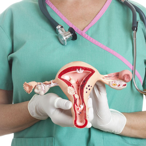 Miomas uterinos
