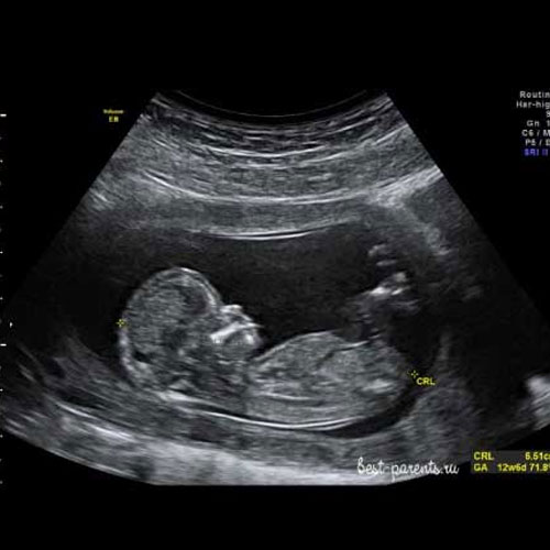 ultrasonido obstetrico